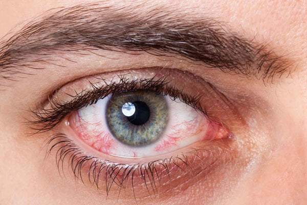 Obat Mata Herbal Klir-Y Menyembuhkan Gangguan Kesehatan Mata